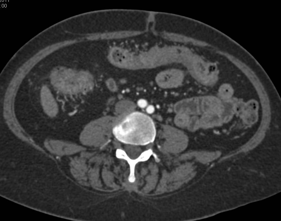 Crohn's Disease of the Large Bowel with Prominent Vasa Recta - CTisus CT Scan