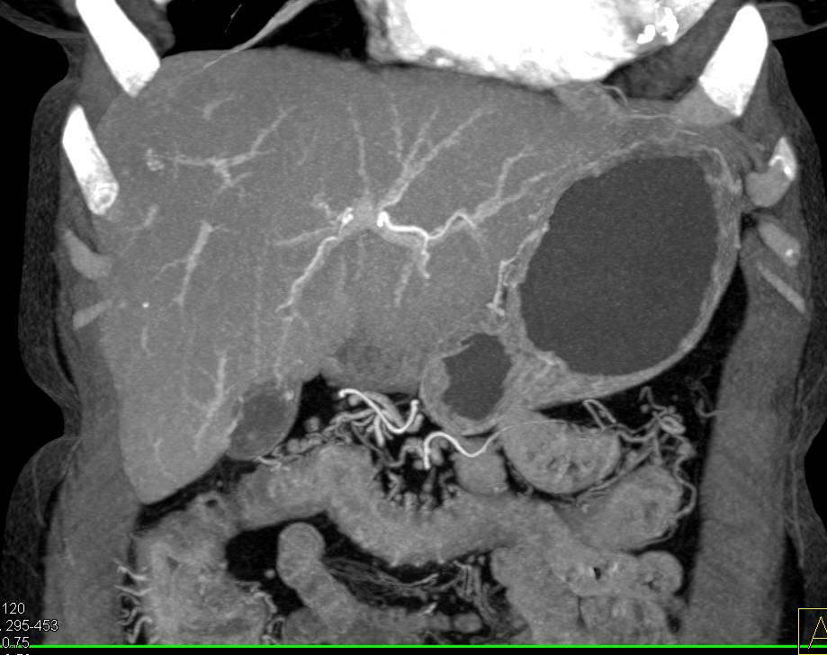 Ulcerative Colitis Right Colon - CTisus CT Scan