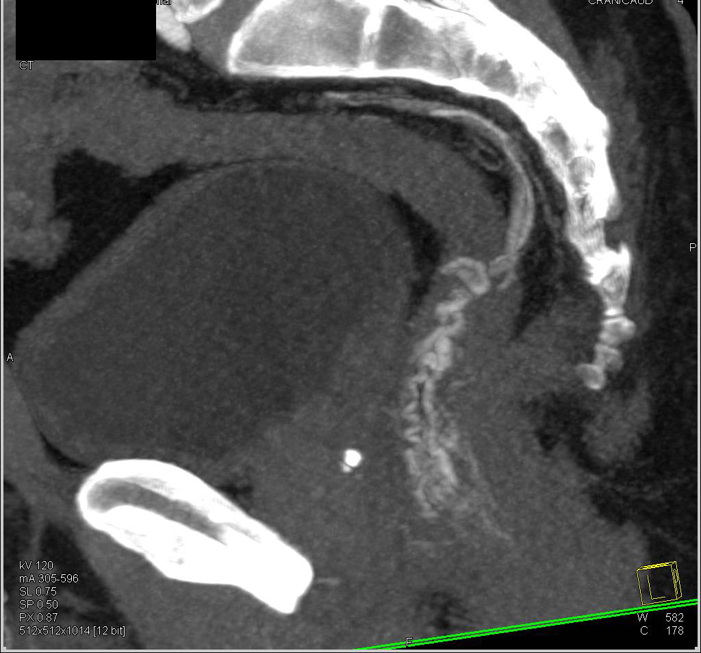 Rectal Varices are the Cause of a Gastrointestinal (GI) Bleed Seen on CTA - CTisus CT Scan