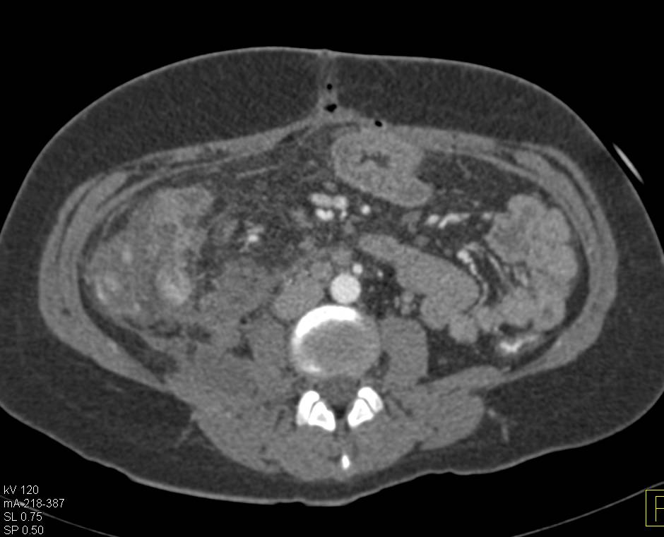 Appendicitis with Abscess - CTisus CT Scan