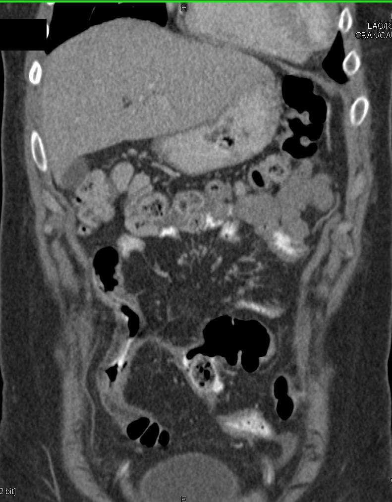 Crohn's Disease with Psoas Abscess - CTisus CT Scan