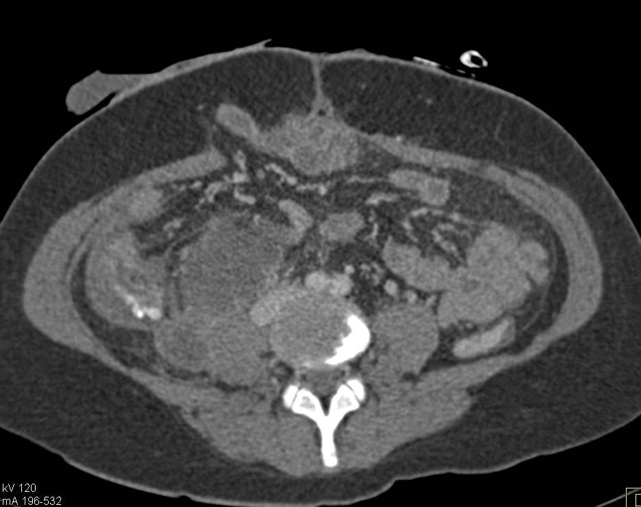 Crohn's Disease with Psoas Abscess - Colon Case Studies - CTisus CT ...