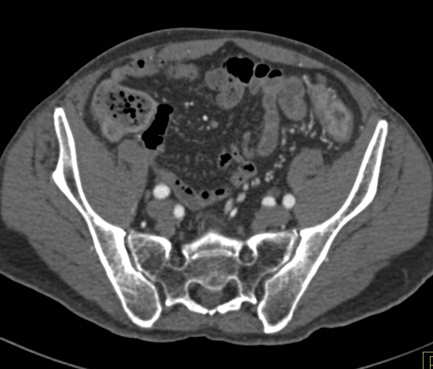 Ulcerative Colitis - CTisus CT Scan