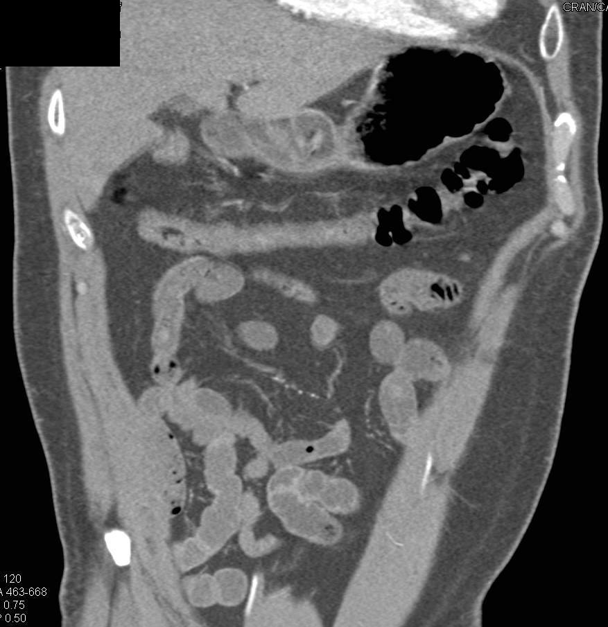 Colitis Transverse Colon - CTisus CT Scan