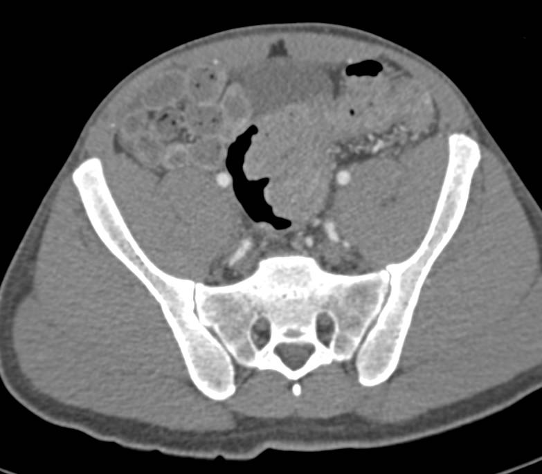 Large Ulcerating Sigmoid Cancer Presenting with a Bleed - CTisus CT Scan