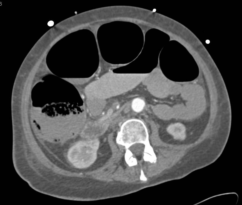 Pneumatosis Right Colon - CTisus CT Scan