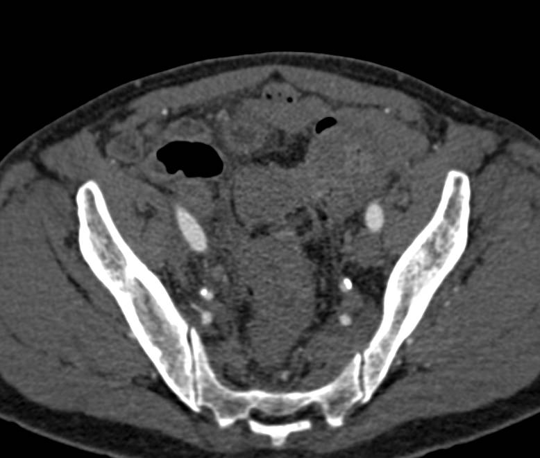 Diverticulitis with Fistulae to the Bladder - CTisus CT Scan