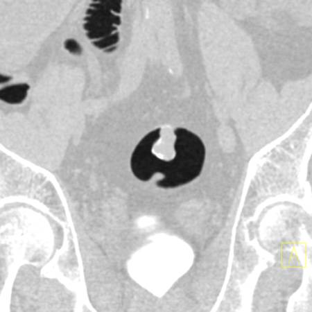 Large pedunculated polyp (2.8cm) in rectum - CTisus CT Scan