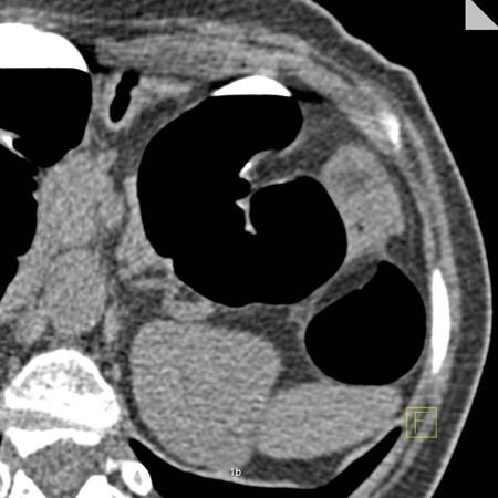 Large lipoma (3.5cm) descending colon. - CTisus CT Scan