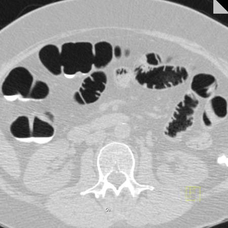 virtual colon: Large polyp (11mm) transverse colon on fold. - CTisus CT Scan