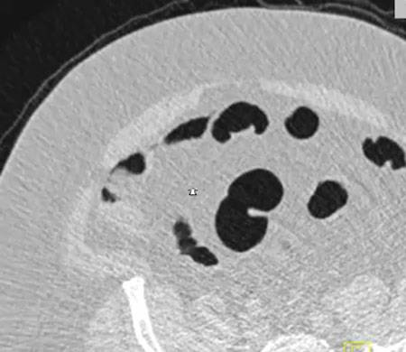 colon polyp ctisus cm case ct virtual ascending studies february added