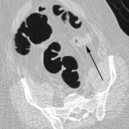 virtual colon: Normal. No polyps. Collapsed segment sigmoid colon open up on supine view. - CTisus CT Scan