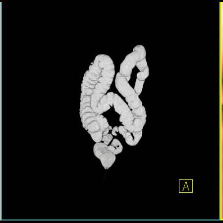 virtual colon: Tortuous sigmoid with sharp angulations related to adhesions from prior surgery. - CTisus CT Scan