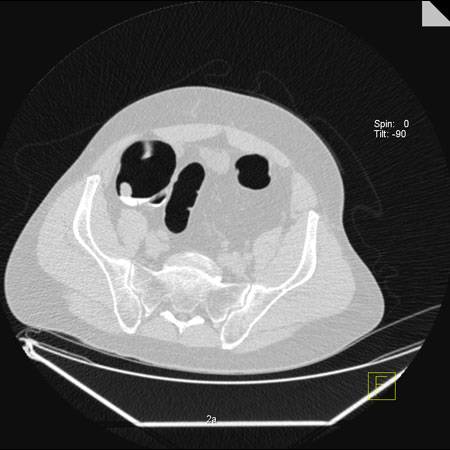 virtual colon: Large 1.6 cm polyp cecum near ileocecal valve. - CTisus CT Scan