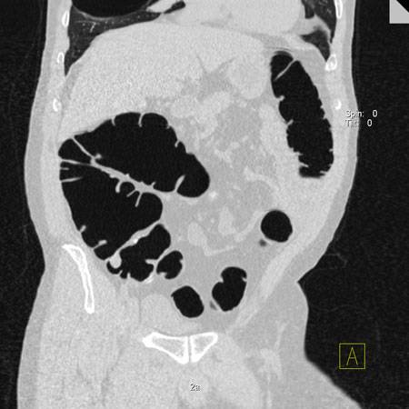 virtual colon: Large 1.6 cm polyp cecum near ileocecal valve. - CTisus CT Scan