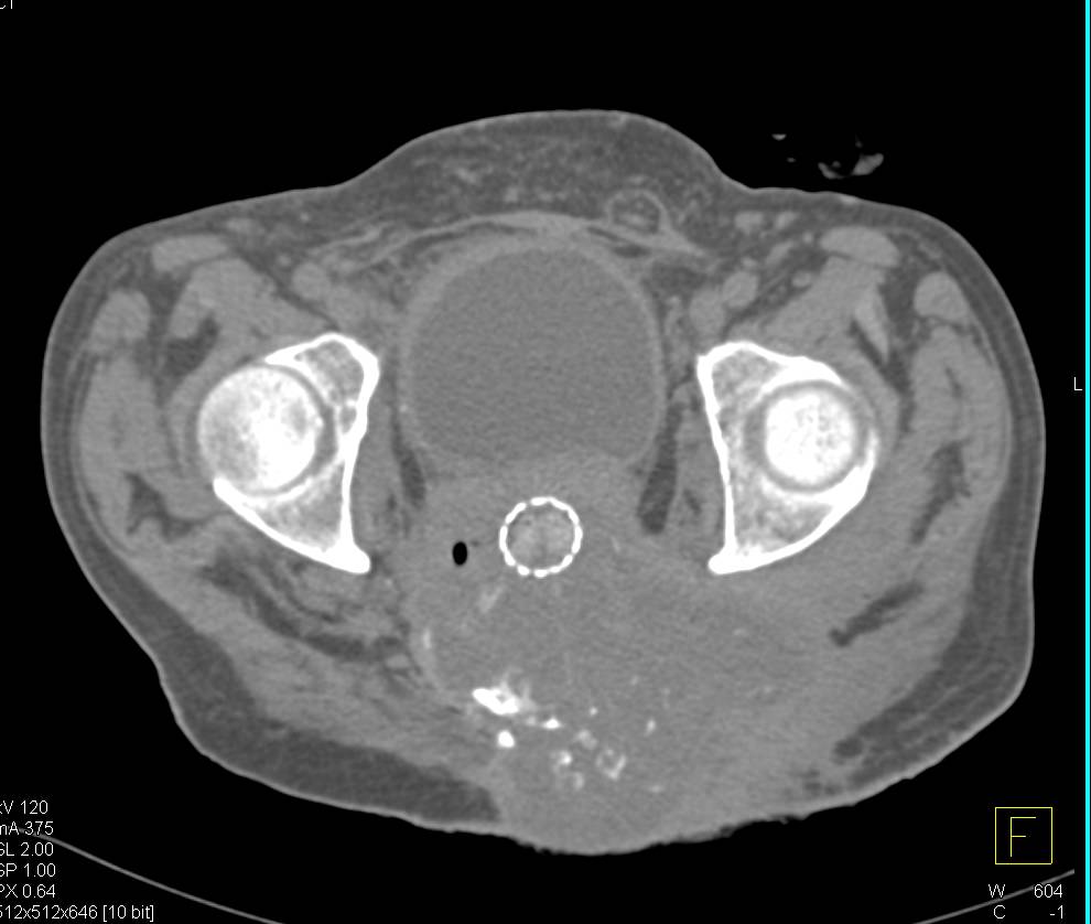 Recurrent Rectal Cancer With Stent Directly Invades the Sacrum - CTisus CT Scan