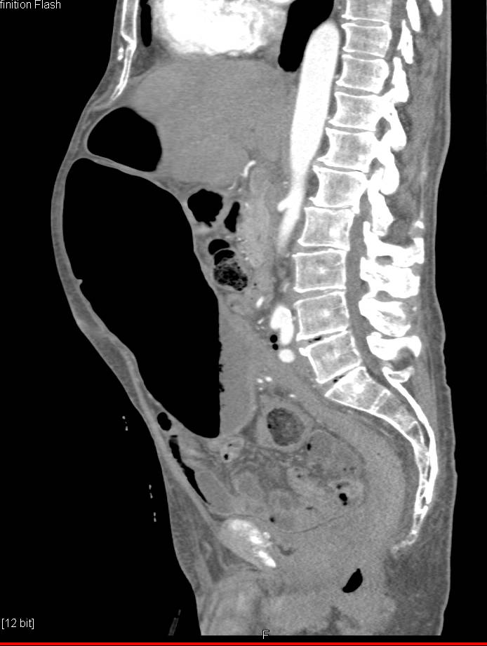 Colonic Volvulus with Marked Distension - CTisus CT Scan