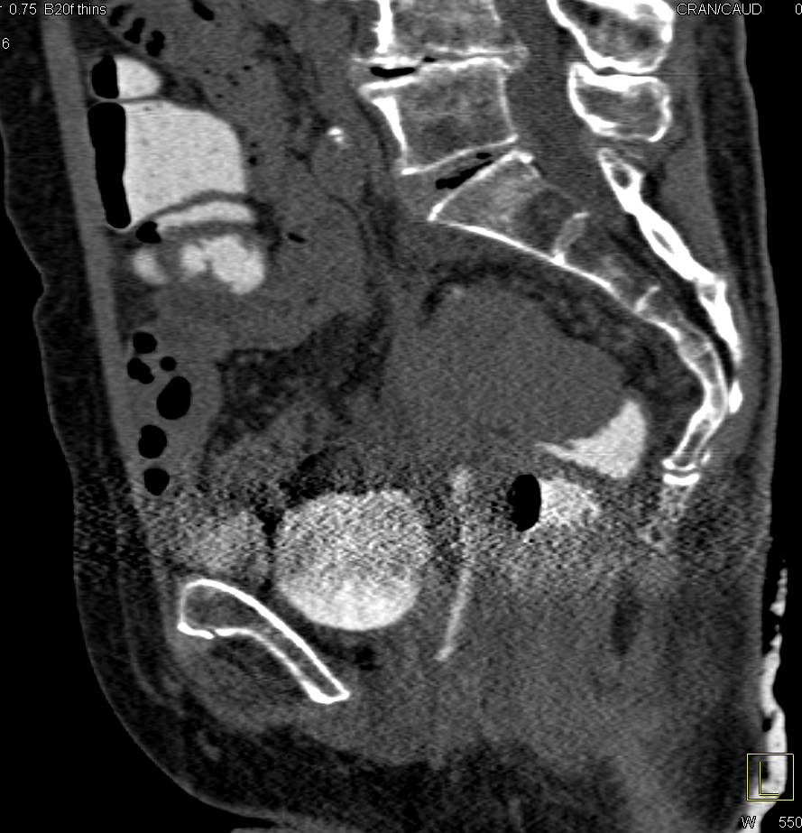 Colovesical Fistulae - CTisus CT Scan