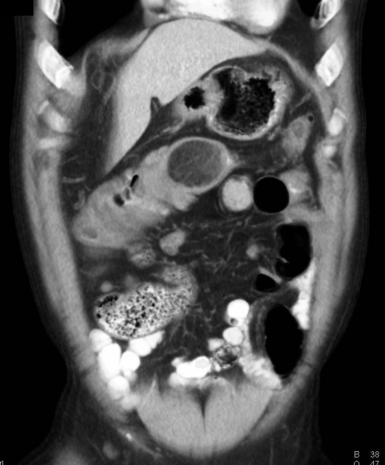 Lipoma as a Lead Point in Colonic Intussusception - CTisus CT Scan