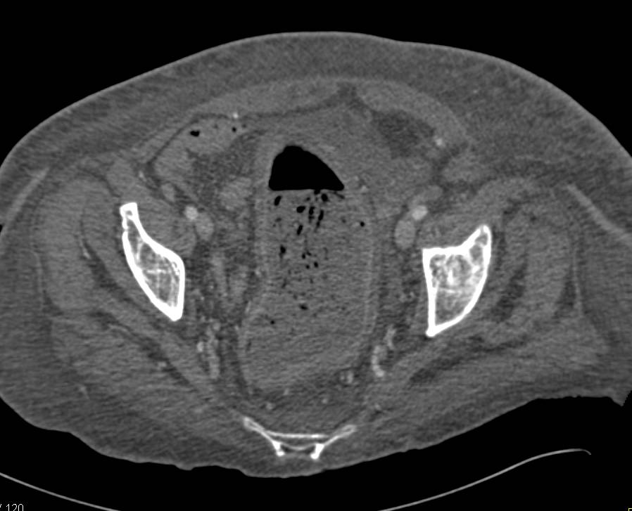 Ischemic Colitis Colon - CTisus CT Scan