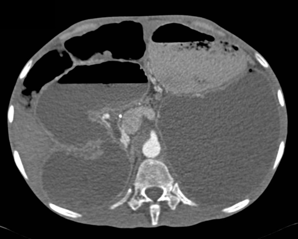 Massive Colonic Bowel Distension due to Volvulus - CTisus CT Scan