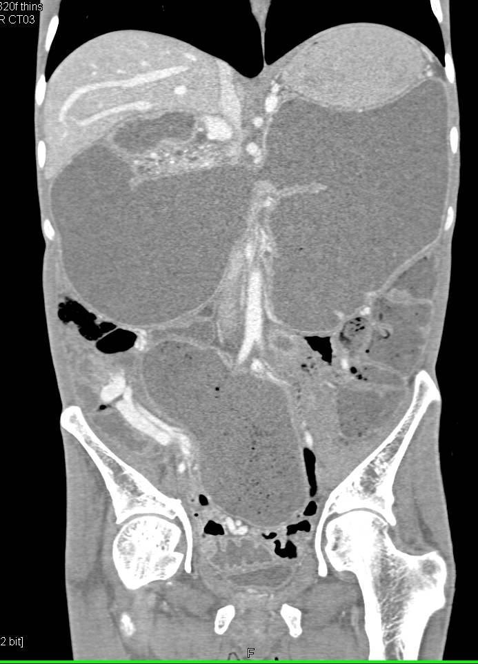 Sigmoid Volvulus - CTisus CT Scan