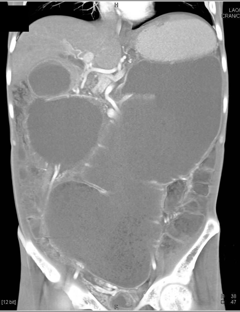 Large Bowel Obstruction due to Volvulus - CTisus CT Scan