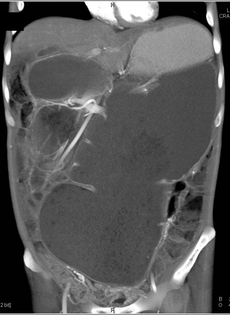 Large Bowel Obstruction Due To Volvulus Colon Case Studies CTisus 