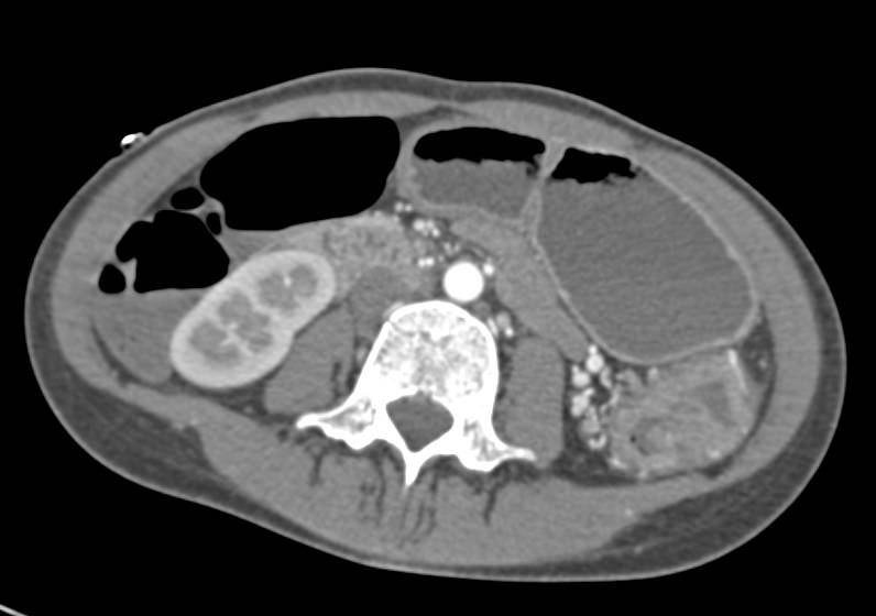 Ulcerative Colitis Left Colon - CTisus CT Scan