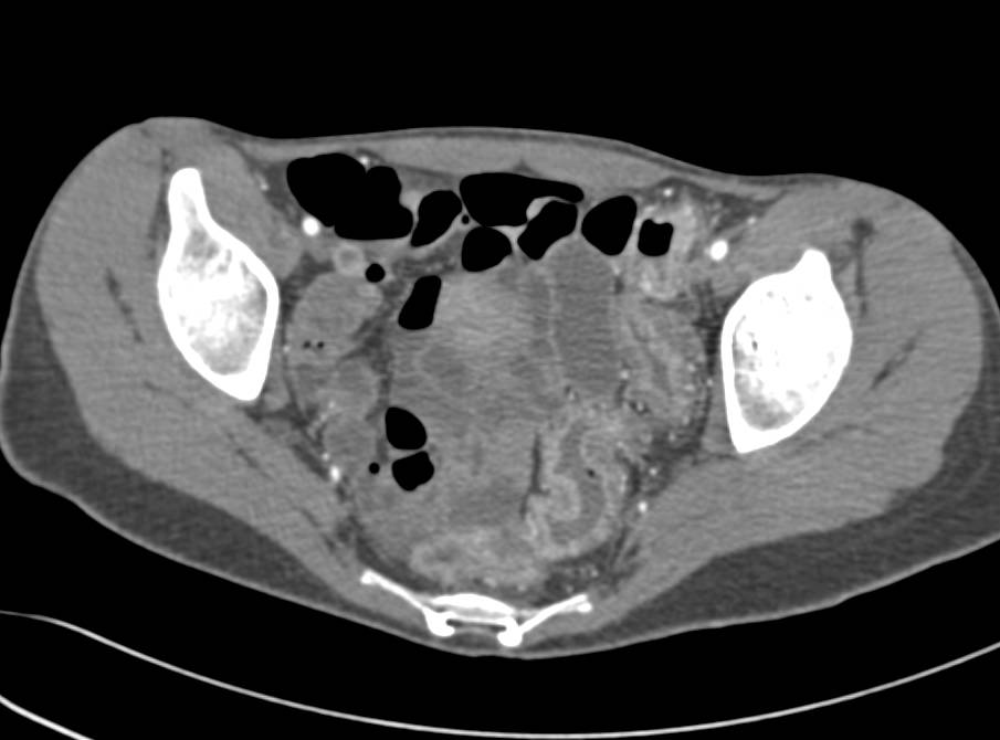 Ulcerative Colitis Left Colon - CTisus CT Scan