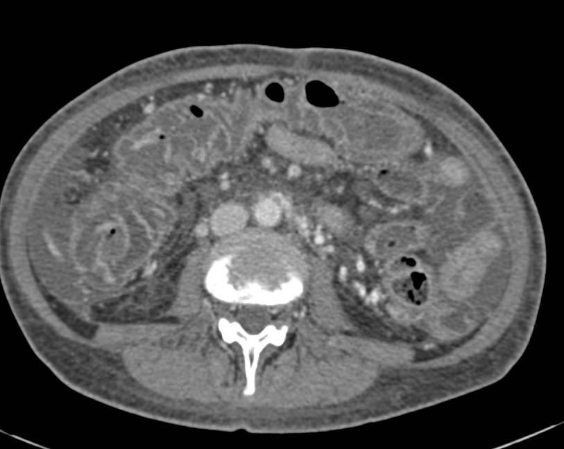 Pseudomembranous Colitis - CTisus CT Scan