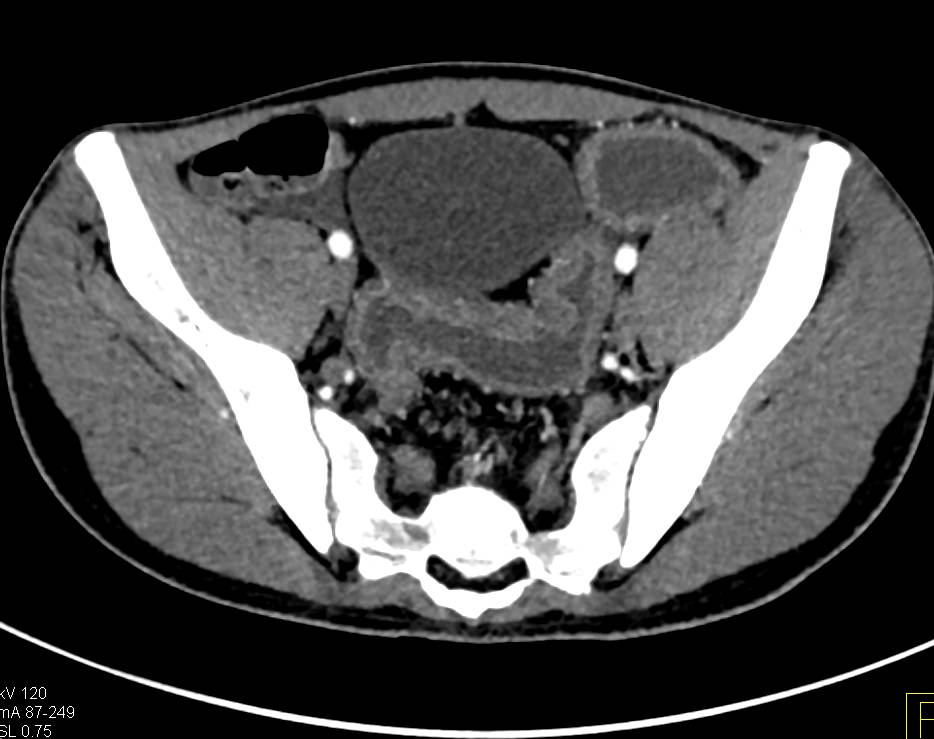 Ulcerative Colitis Especially Involving Sigmoid Colon - CTisus CT Scan