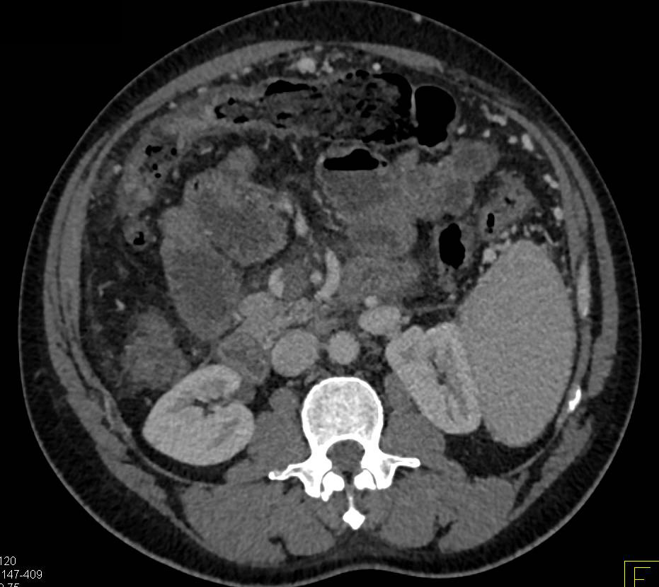 Thickened Colon in Patient with Cirrhosis - CTisus CT Scan