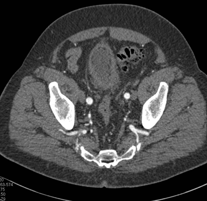 Early Colovesical Fistulae - CTisus CT Scan