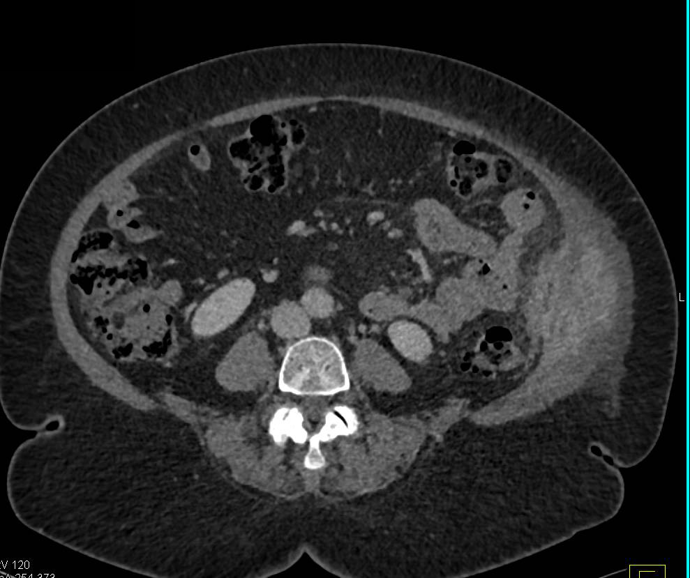 Diverticulitis Extends into the Left Abdominal Wall - CTisus CT Scan