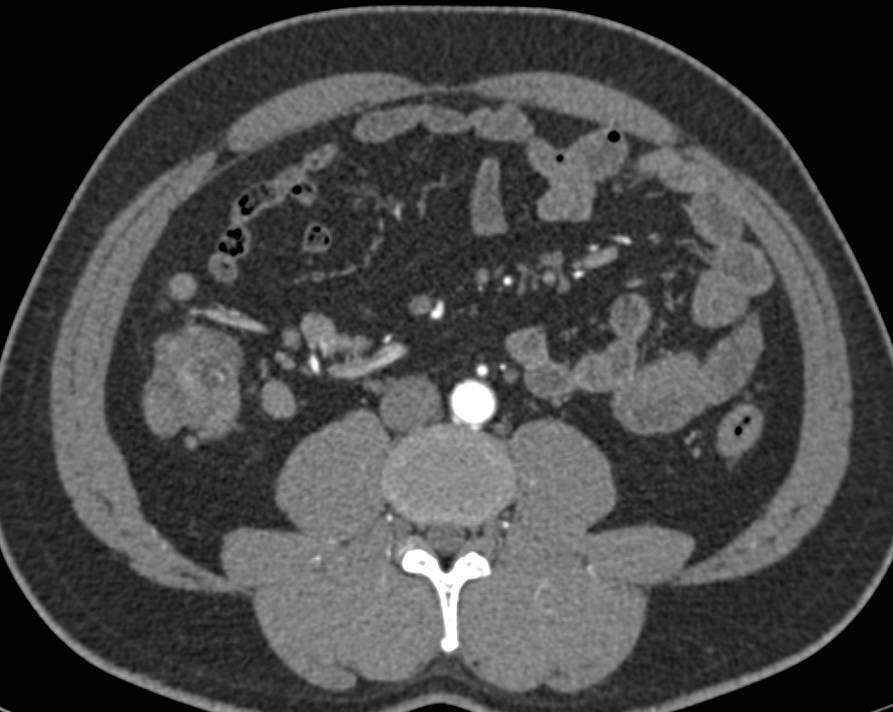 Infiltrating Cecal Carcinoma - CTisus CT Scan