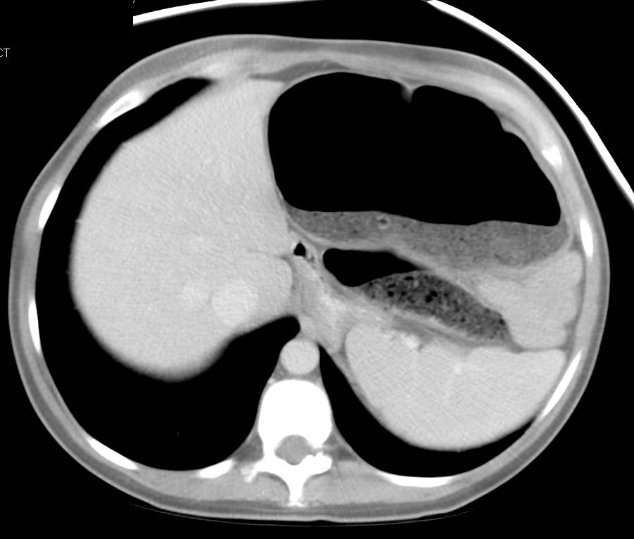 Cystic Fibrosis with Large Amount of Fluid and Stool in Colon - CTisus CT Scan