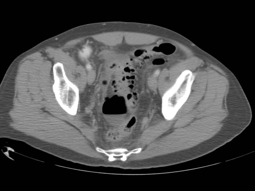 Diverticulitis with Perforation and Abscess - CTisus CT Scan