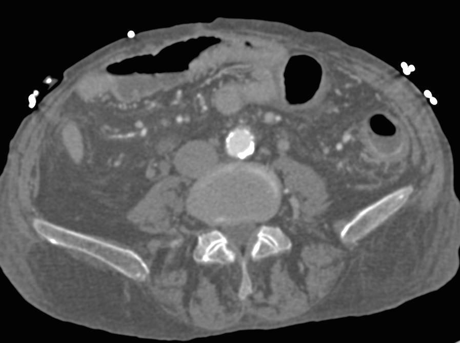 Ischemic Colitis Left Colon - CTisus CT Scan