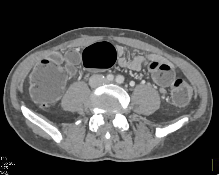 Colitis Involves Lower Rectum with Enhancement and Dilated Fluid Filled Colon - CTisus CT Scan