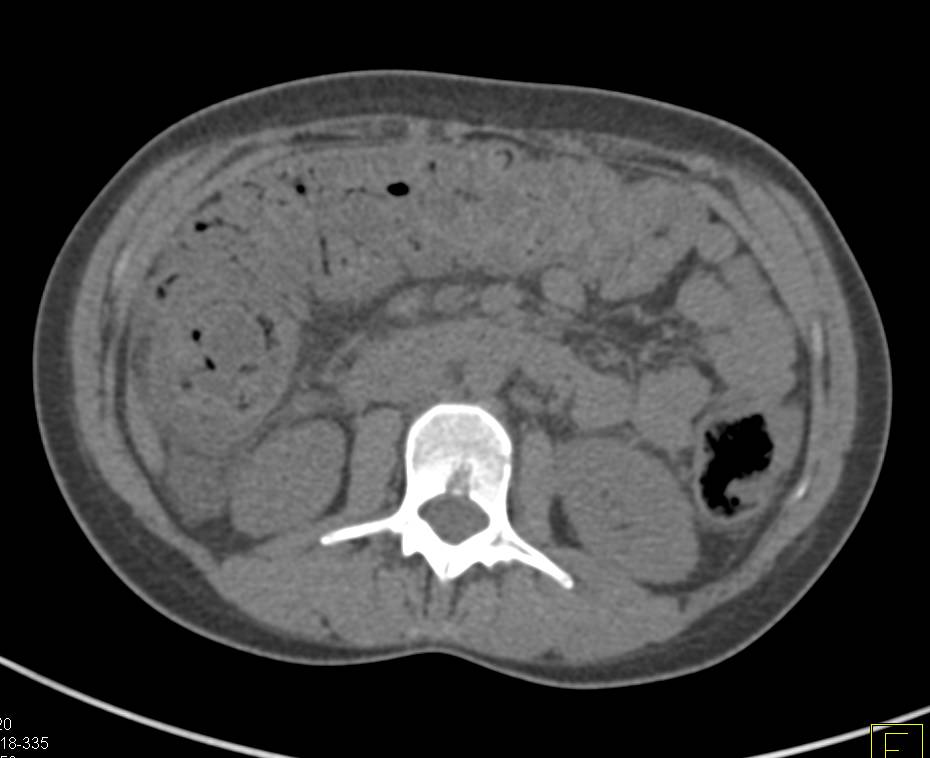 Pseudomembranous Colitis - CTisus CT Scan