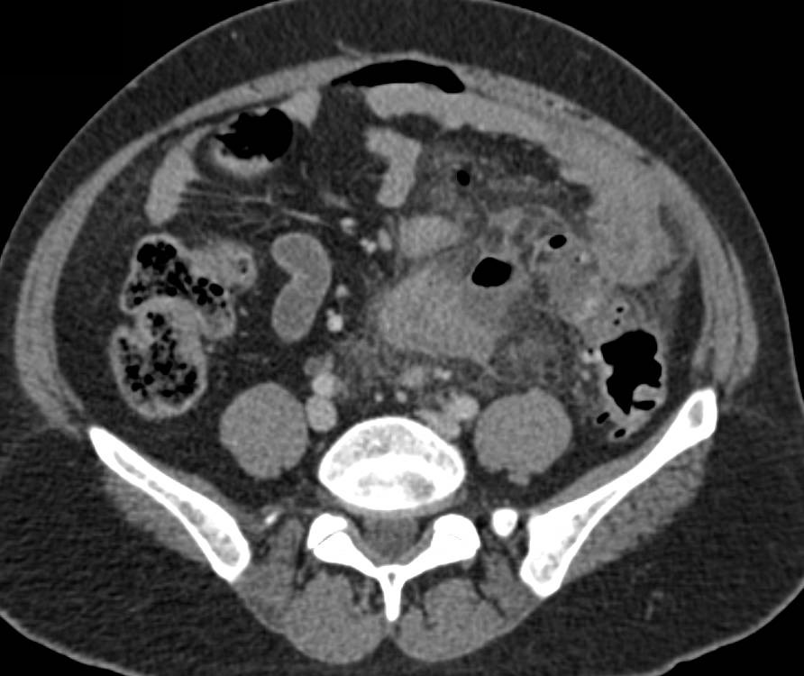 Diverticulitis with Pneumoperitoneum - CTisus CT Scan