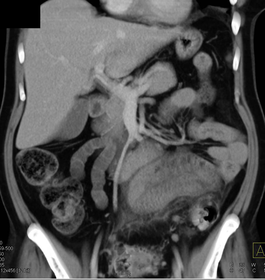 Diverticulitis with Early Small Bowel Obstruction (SBO) and Pneumoperitoneum - CTisus CT Scan