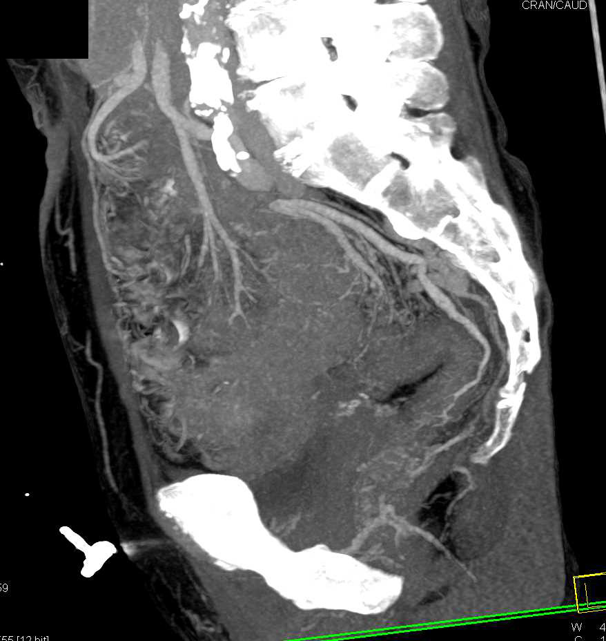 Colitis Involves Rectum - CTisus CT Scan