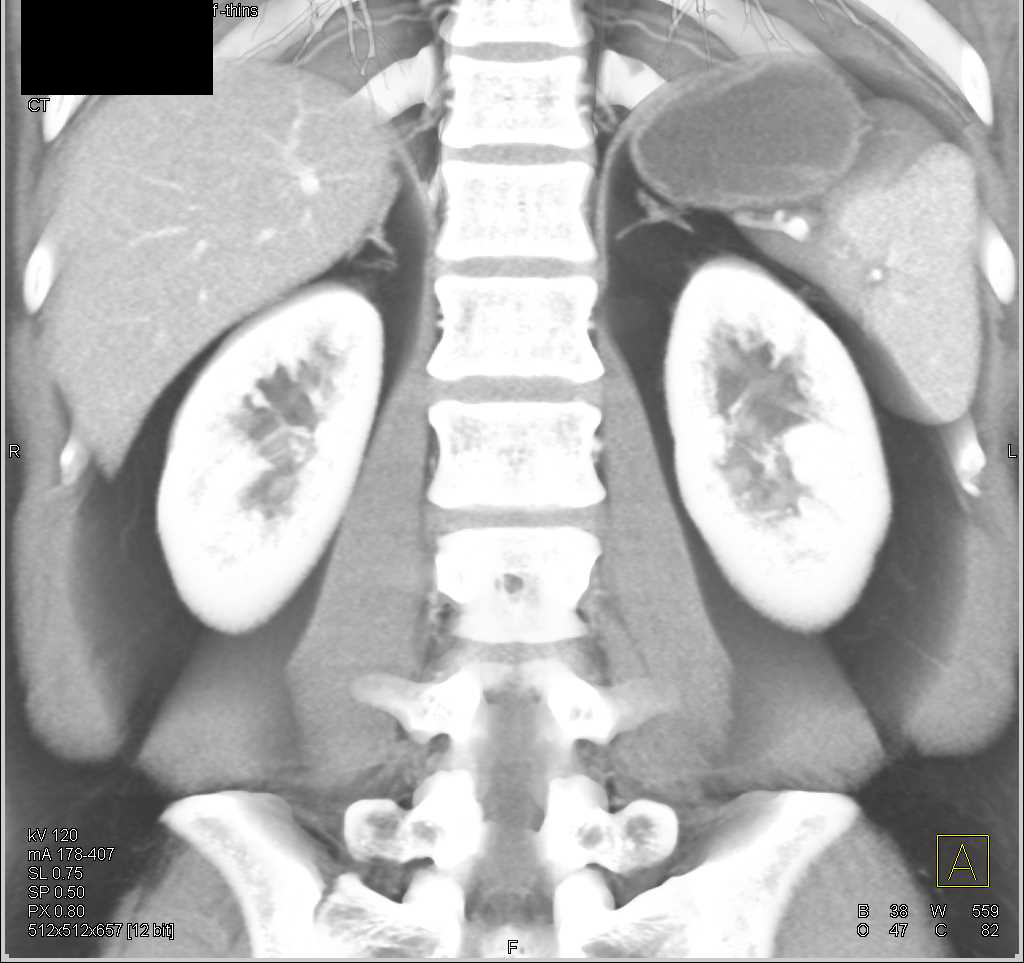 Crohn's Colitis Right Colon - CTisus CT Scan