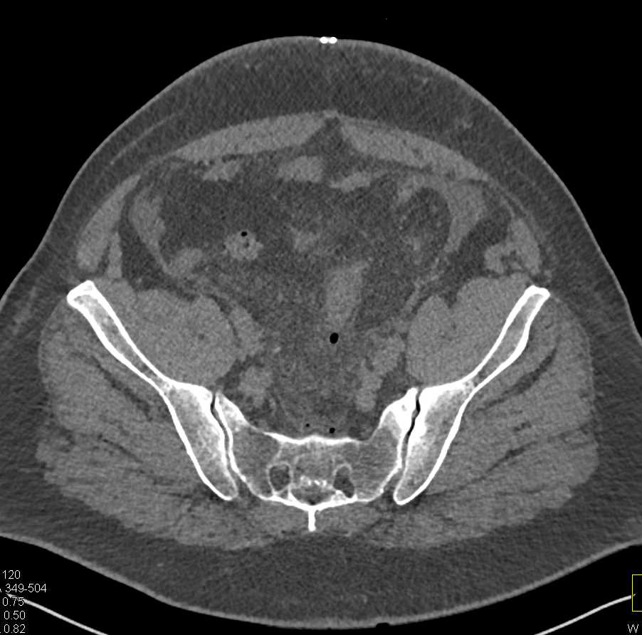 Diverticulitis with Early Entero-Vesicle Fistulae - CTisus CT Scan