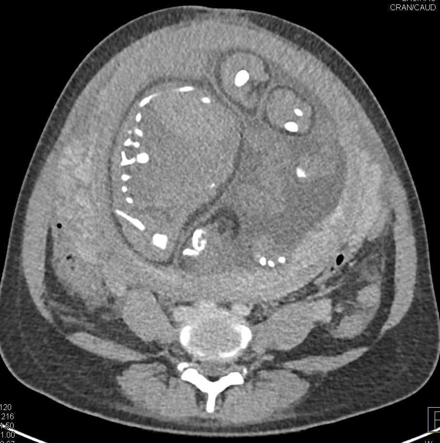 Appendicitis in a Pregnant Patient - CTisus CT Scan