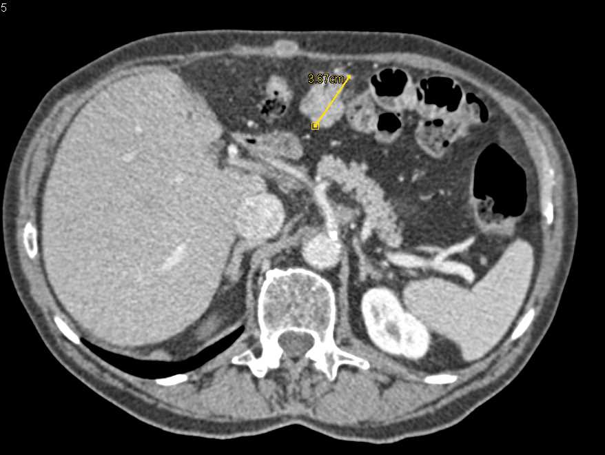 Omental Implants from Colon Cancer - CTisus CT Scan