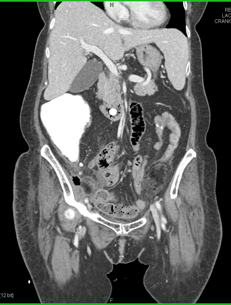 Colitis of Right Colon - CTisus CT Scan