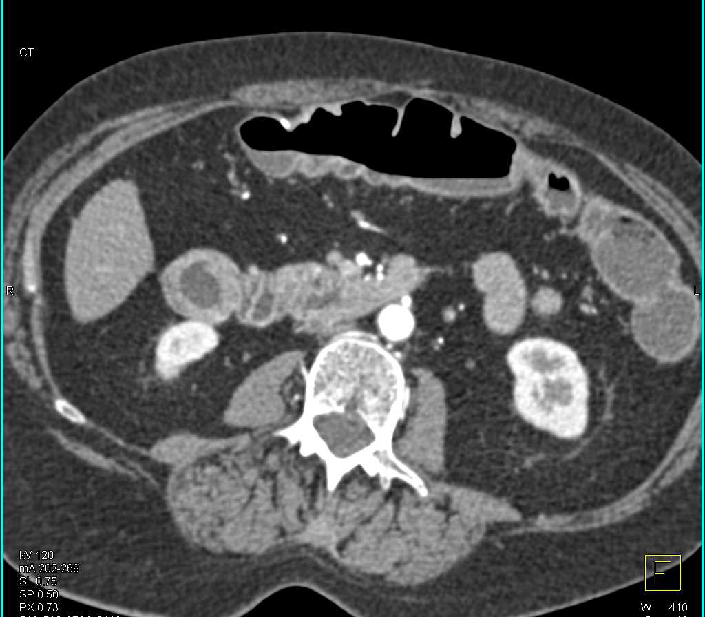 Crohn's Colitis Colon Including the Rectum with CTA - CTisus CT Scan